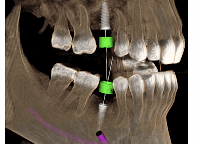 Arcada dentária com prótese